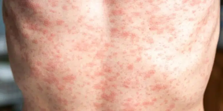 Rougeole : une résurgence inquiétante à l&rsquo;approche du Mondial 2026