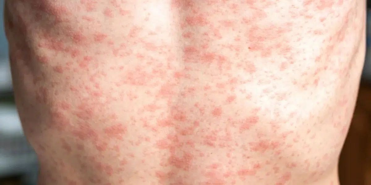 Rougeole : une résurgence inquiétante à l'approche du Mondial 2026